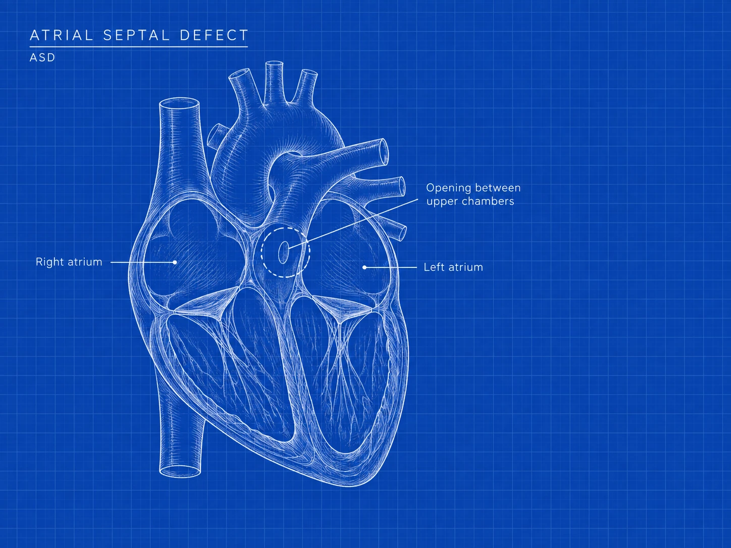 ASD: where the difference is. An opening in the wall between the two upper chambers of the heart.