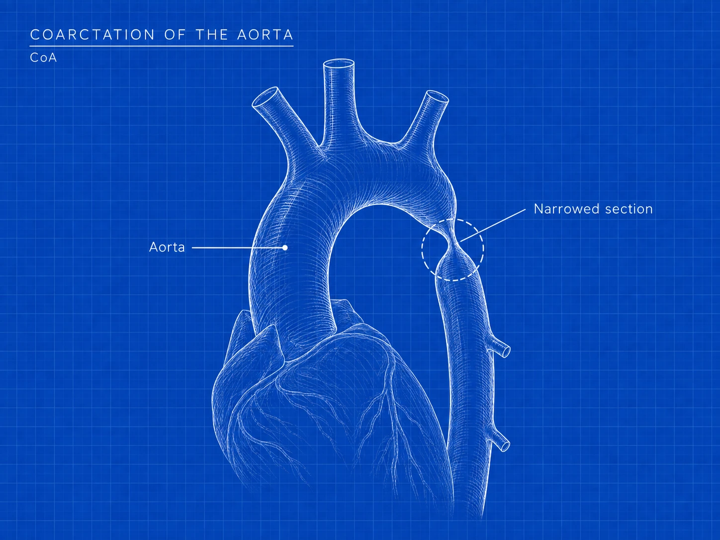CoA: where the difference is. Part of the aorta—the artery carrying oxygen-rich blood to the body—is narrower than usual. The heart must work harder to push blood through.
