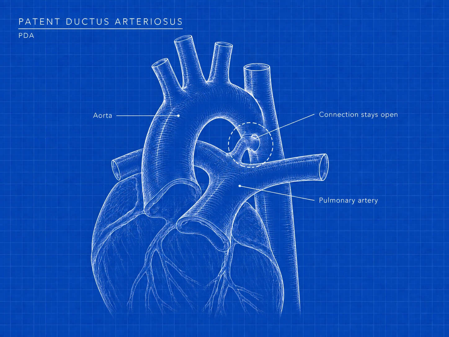 PDA: where the difference is. A blood vessel connecting the aorta and pulmonary artery before birth stays open after birth.