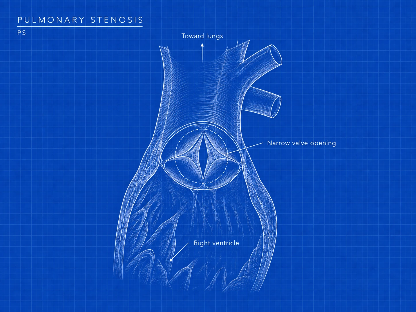 PS: where the difference is. A narrowed or stiff pulmonary valve restricts blood flow from the heart toward the lungs.