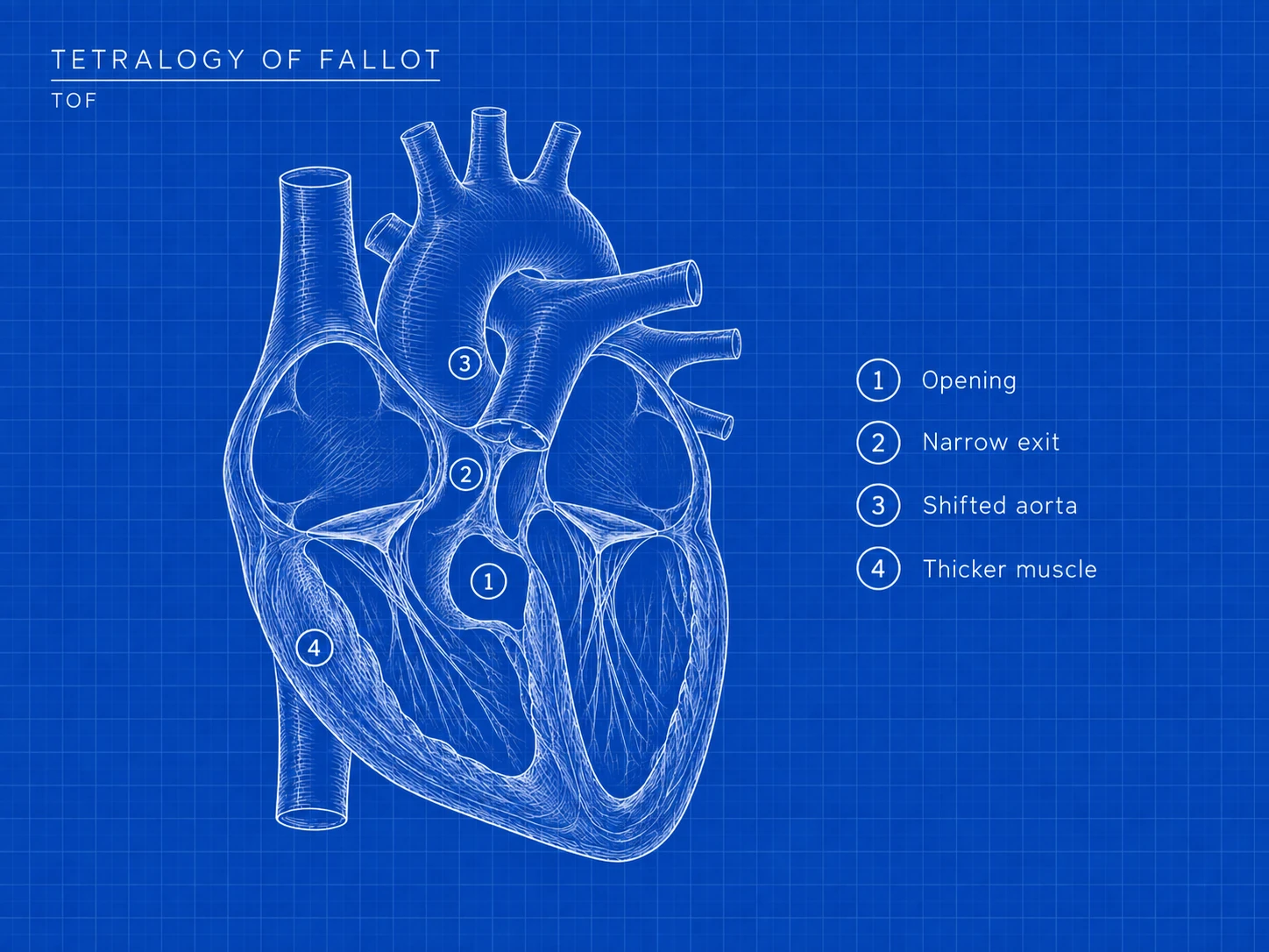 TOF: where the difference is. A VSD; narrowing toward the lungs; an aorta positioned over the VSD, receiving blood from both lower chambers; and a thickened right lower chamber muscle. Together, these can reduce the oxygen reaching the body.