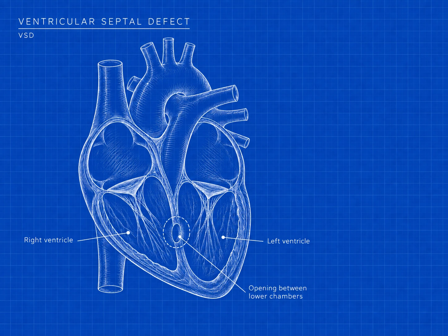 VSD: where the difference is. An opening in the wall between the two lower chambers of the heart.